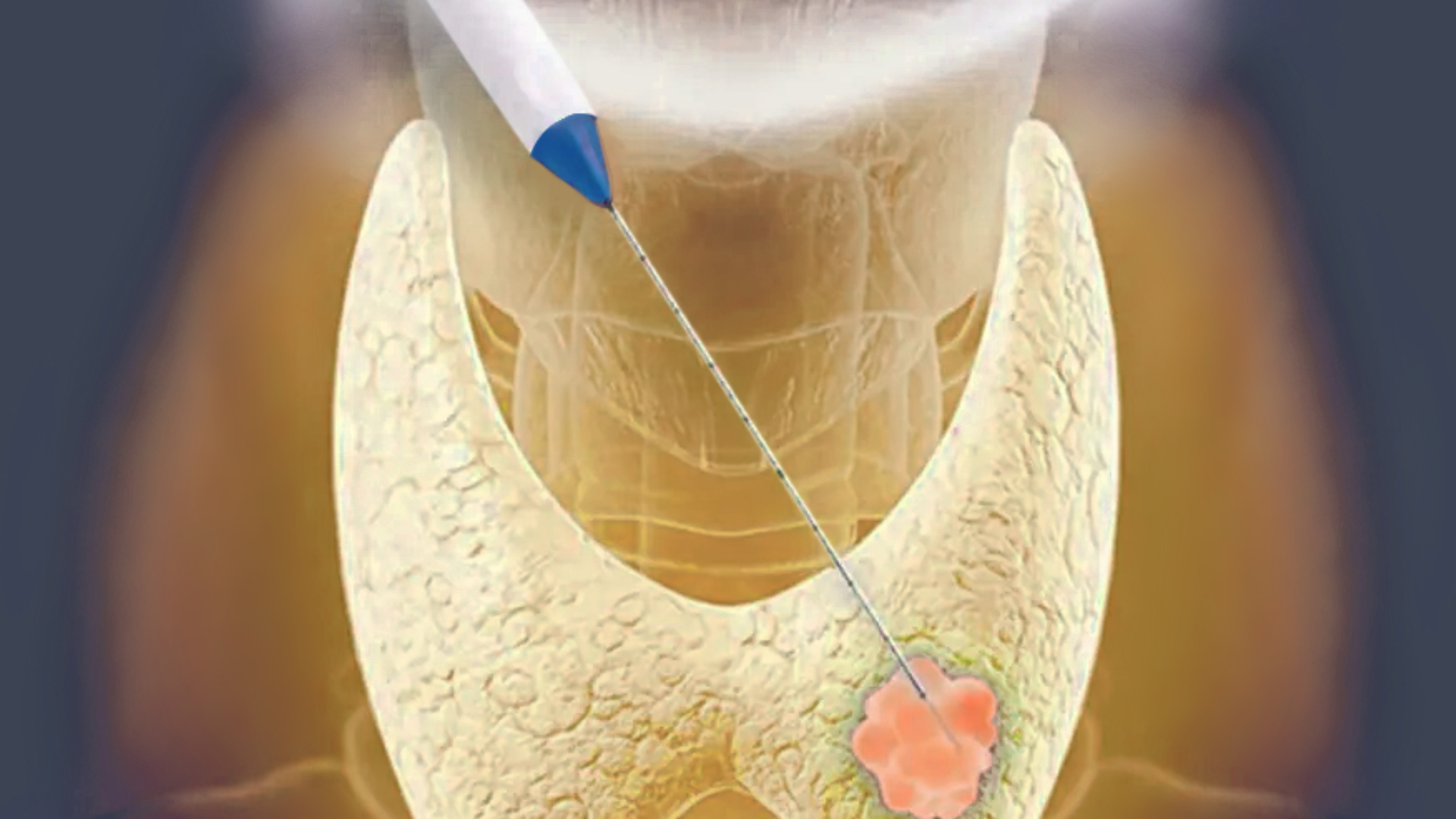 Girişimsel radyolojide uygulanan ameliyatsız işlemler nelerdir?