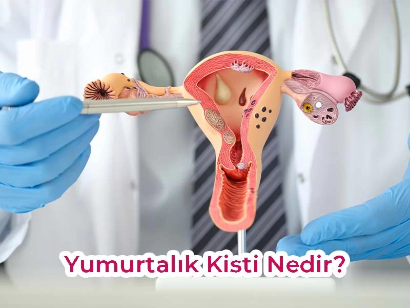 Yumurtalık Kisti Tedavisi: Kapsamlı Rehber ve Güncel Yaklaşımlar